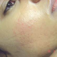 after acne